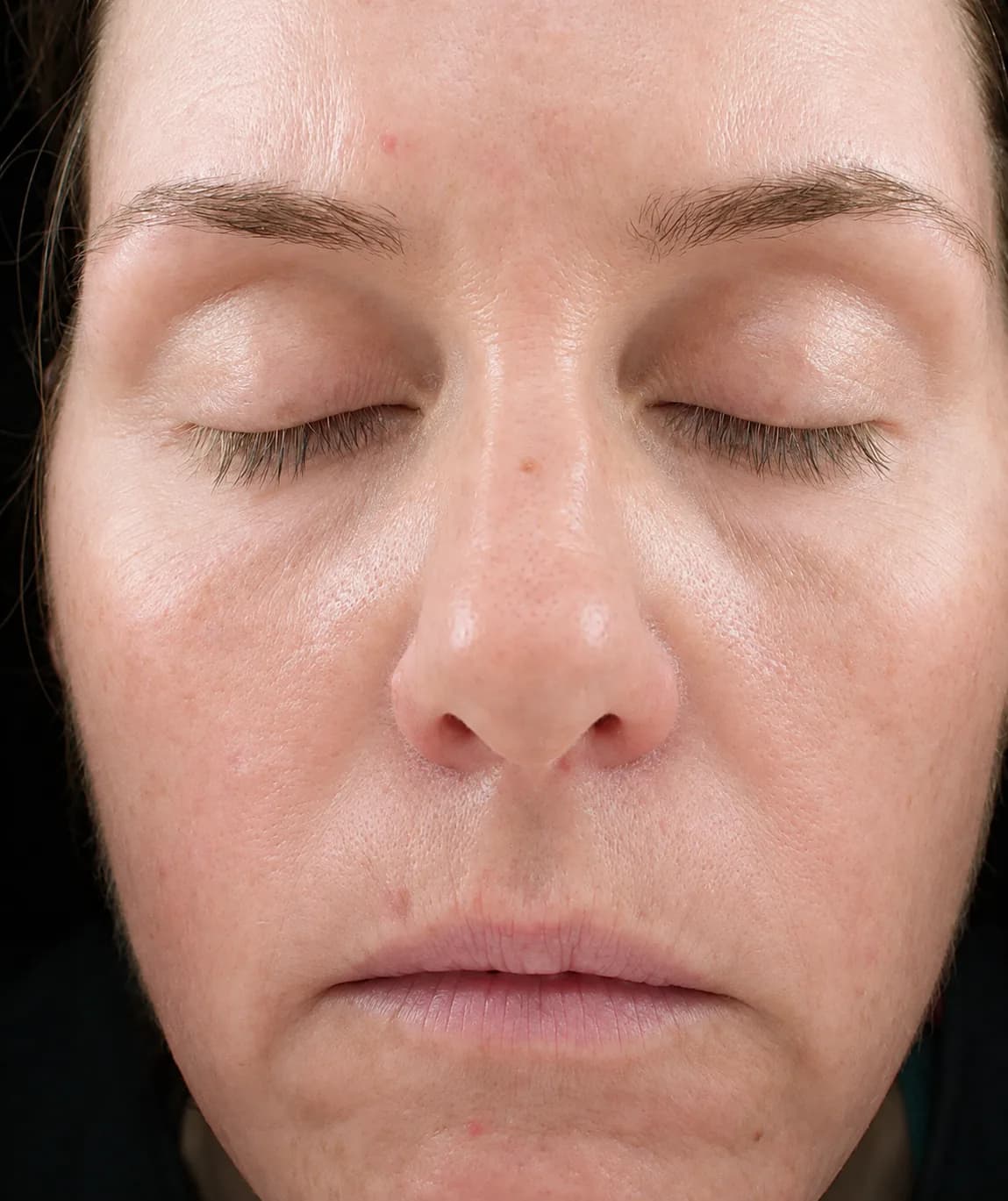 Pigment facial treatment after
